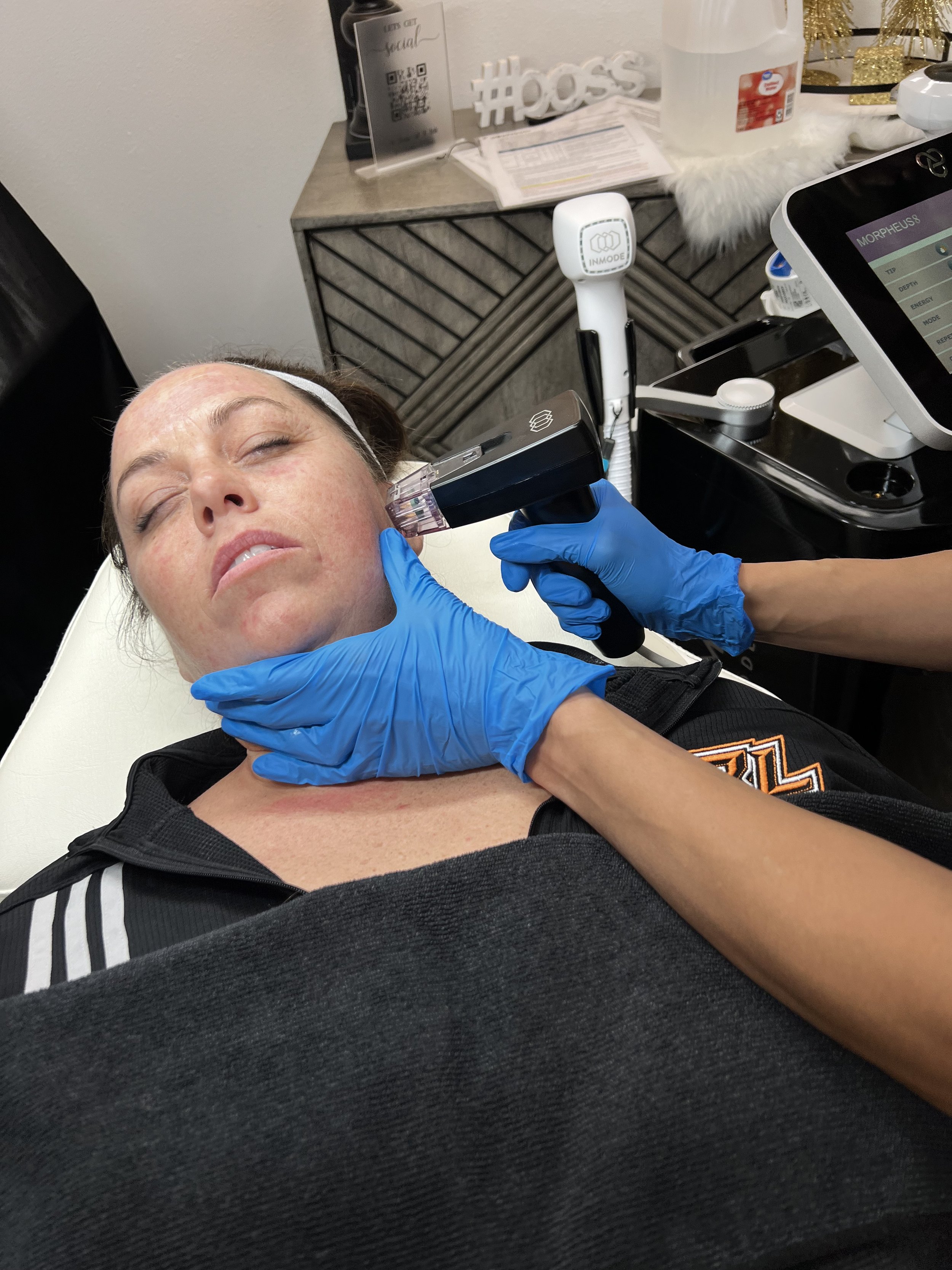 Micro needling of Morpheus 8