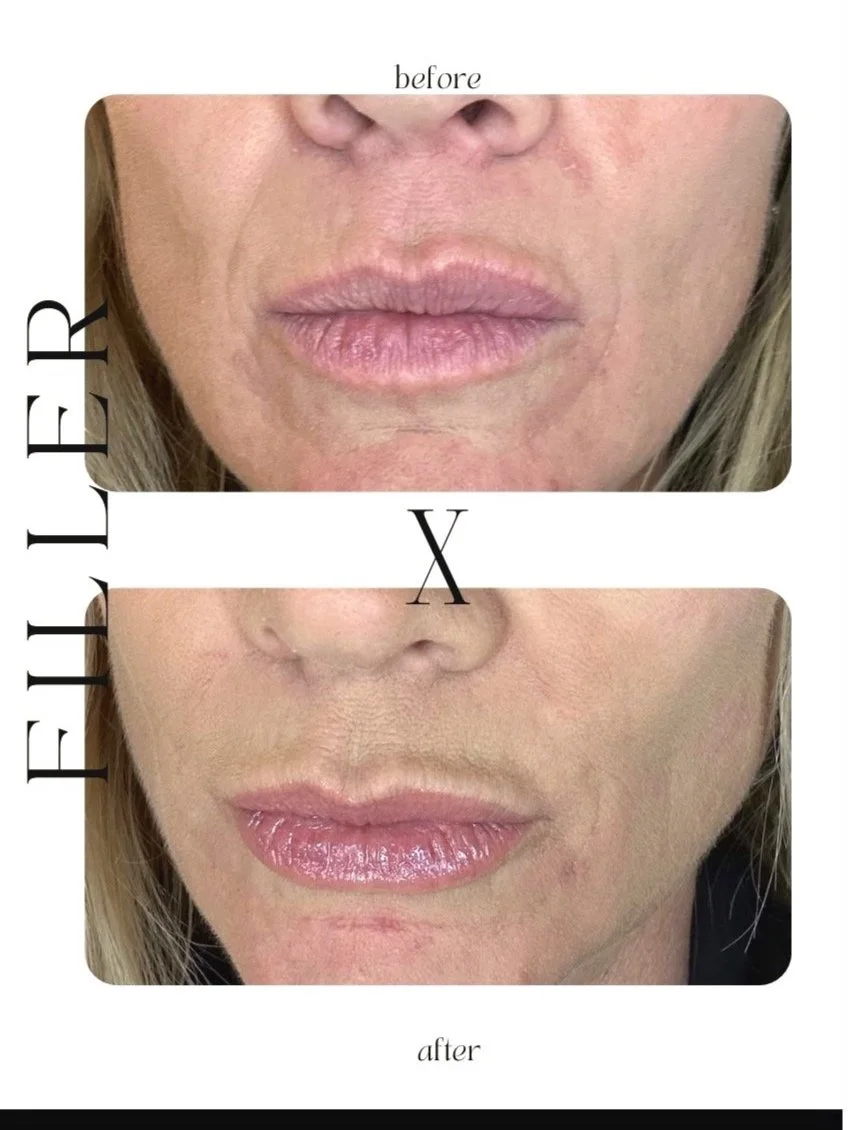Comparison of lips before and after appearing to have undergone a cosmetic procedure, showing fuller, glossy lips in the after image.