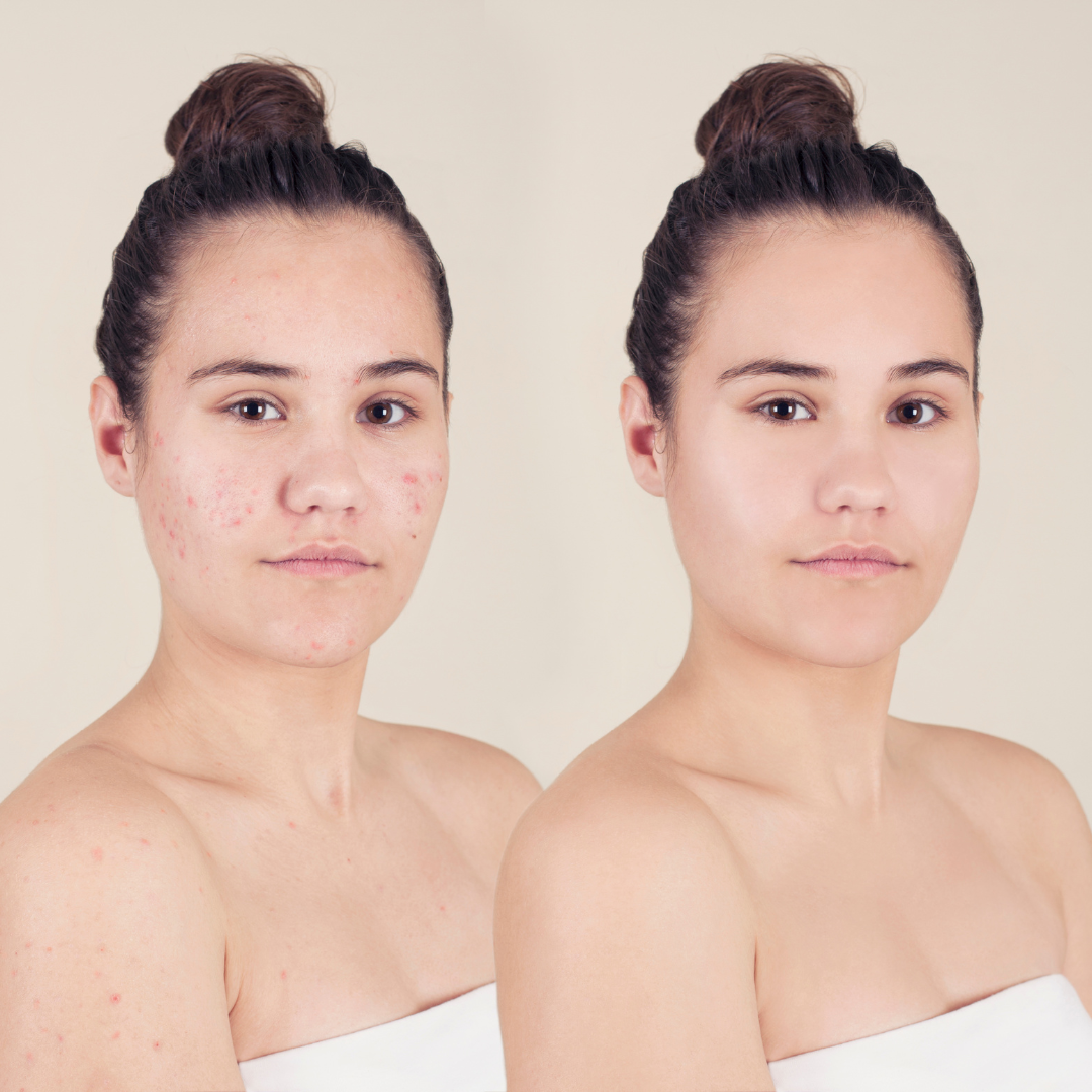 Acne Peel