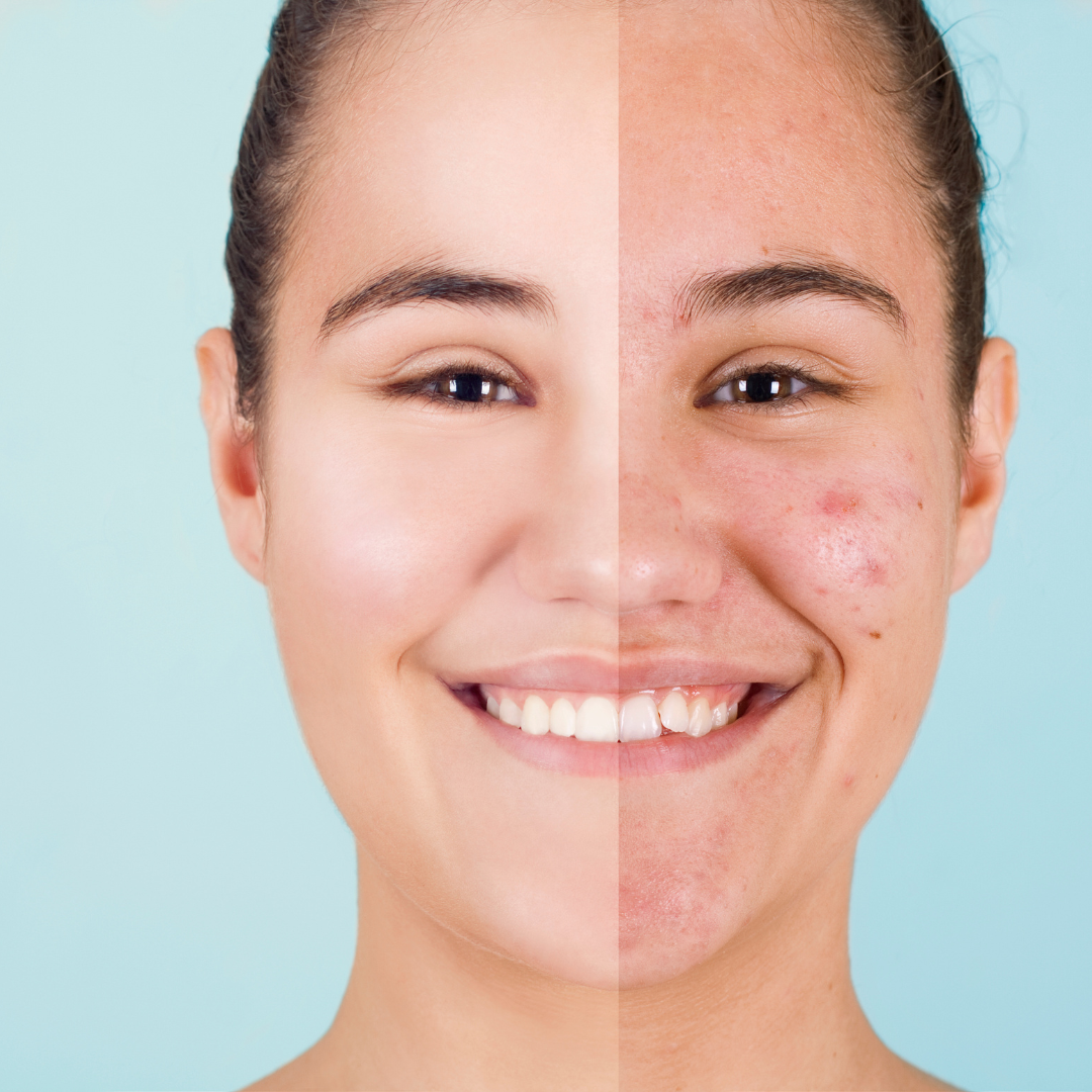 Jet Plasma Acne Facial