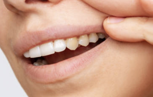 Why aren’t my child’s adult teeth as white as their baby teeth?