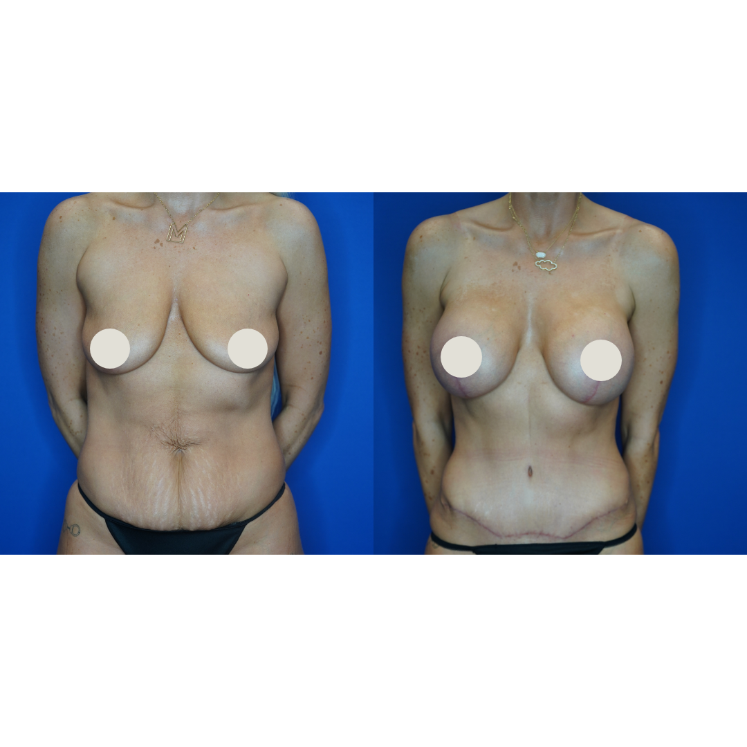  Details: Mastopexy augmentation, standard abdominoplasty with liposuction. R: SCF-450, L: SCF-450 