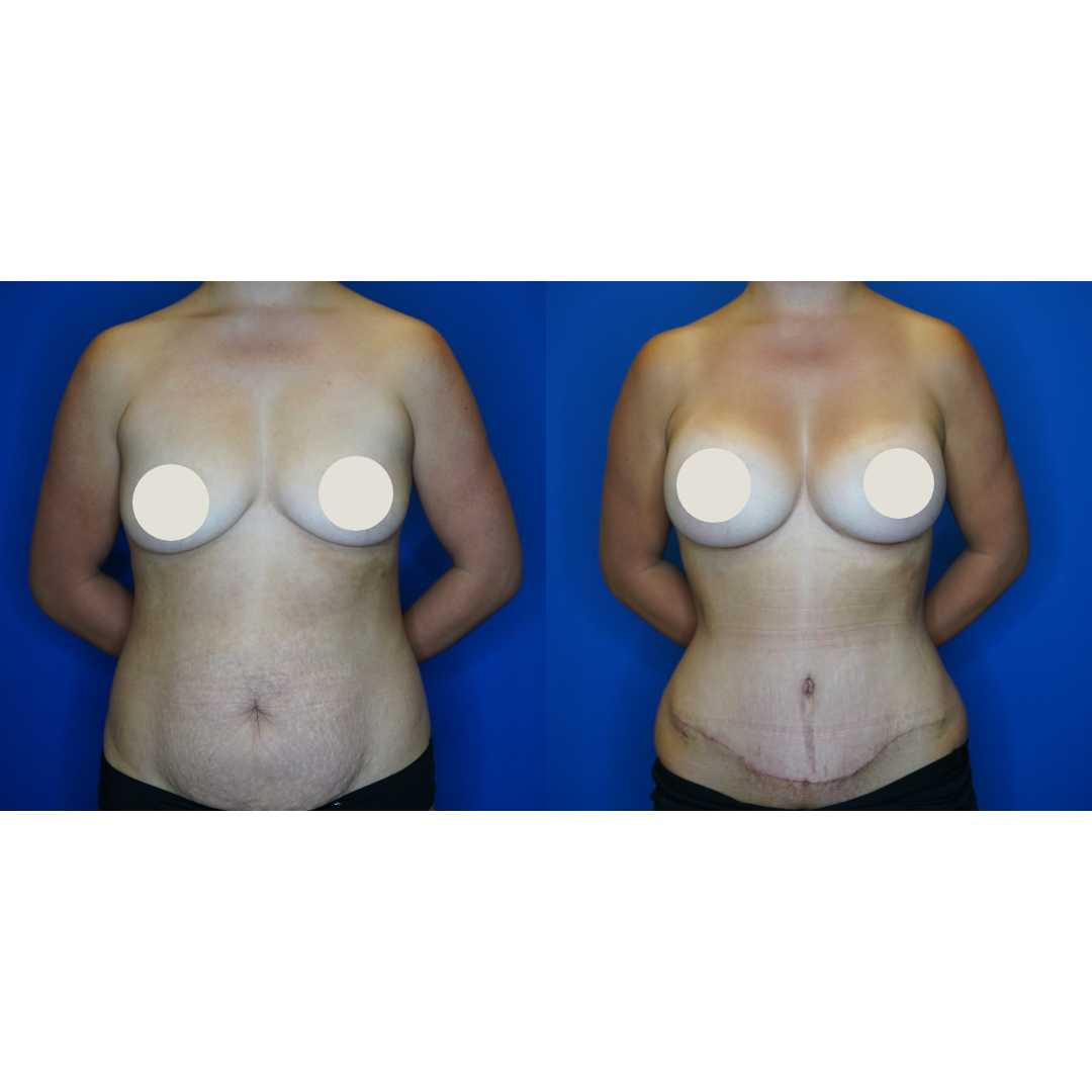  Details: Standard abdominoplasty with bilateral augmentation, liposuction to flanks, fat grafting to bilateral breasts R: SCF-450, L: SCF-450 