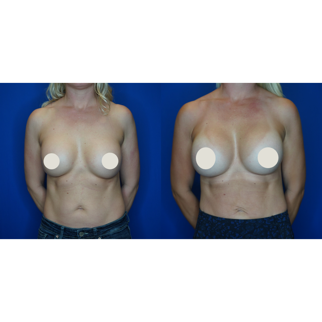  Details: Bilateral silicone implant exchange, nipple reduction, fat grafting bilateral breasts 