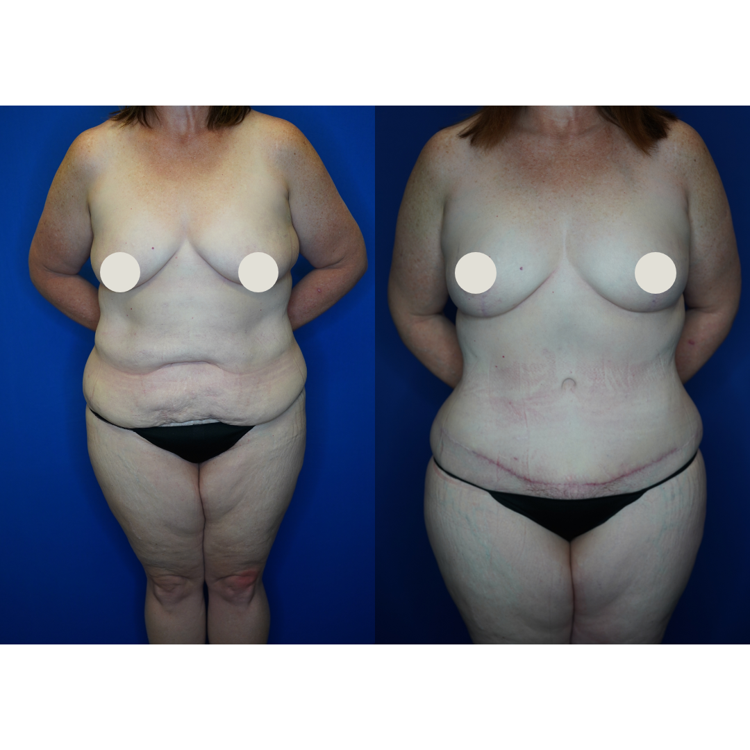  Details: Abdominoplasty with liposuction, mastopexy, liposuction to posterior flanks, fat grafting to bilateral breasts, bilateral brachioplasty 