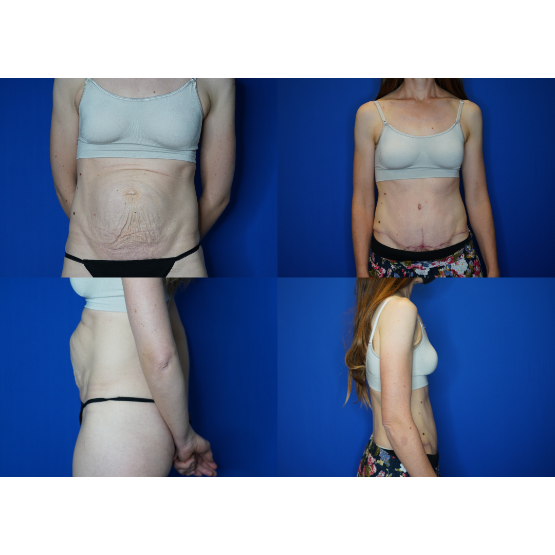  Details: Abdominoplasty with liposuction to flanks 