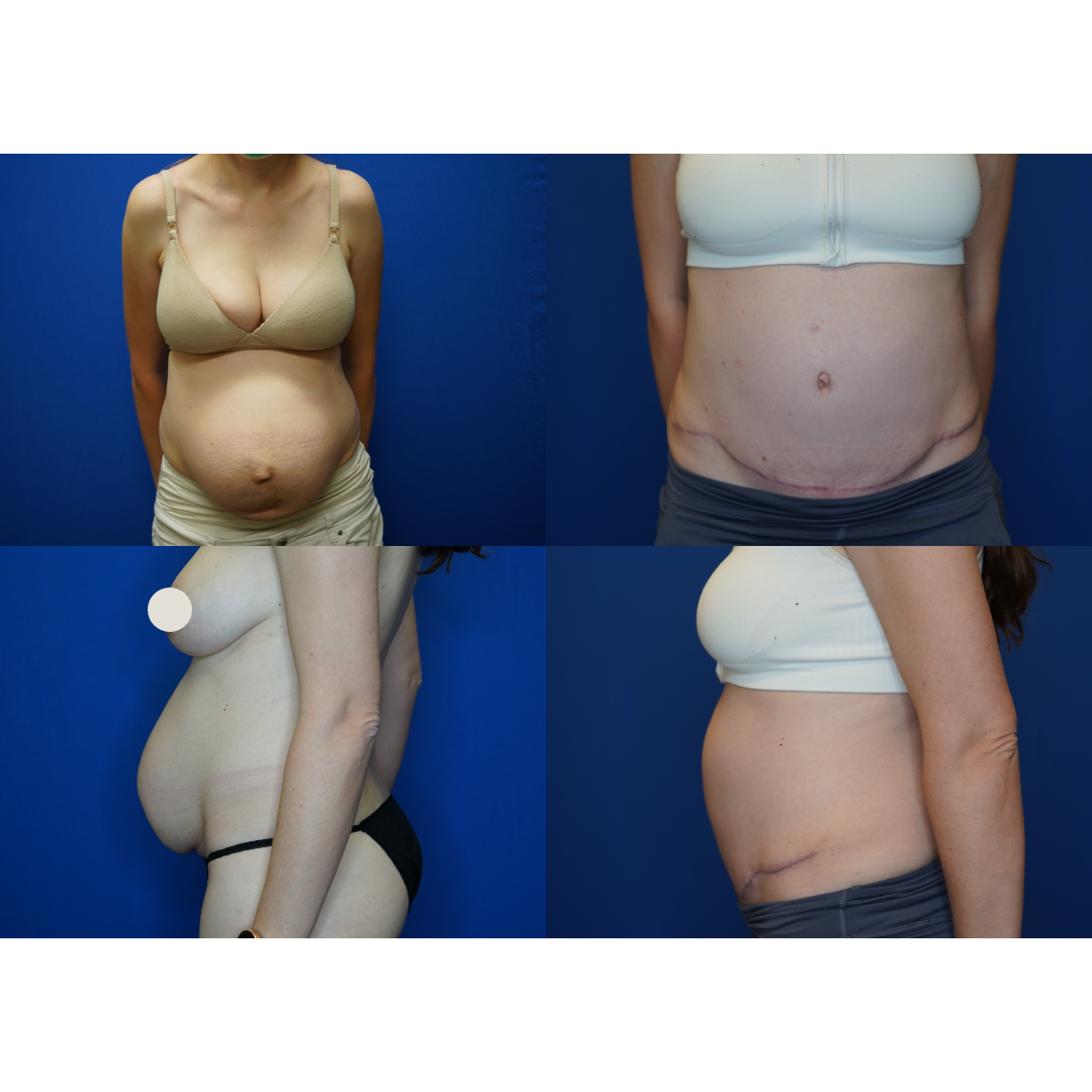  Details: Abdominoplasty with liposuction 