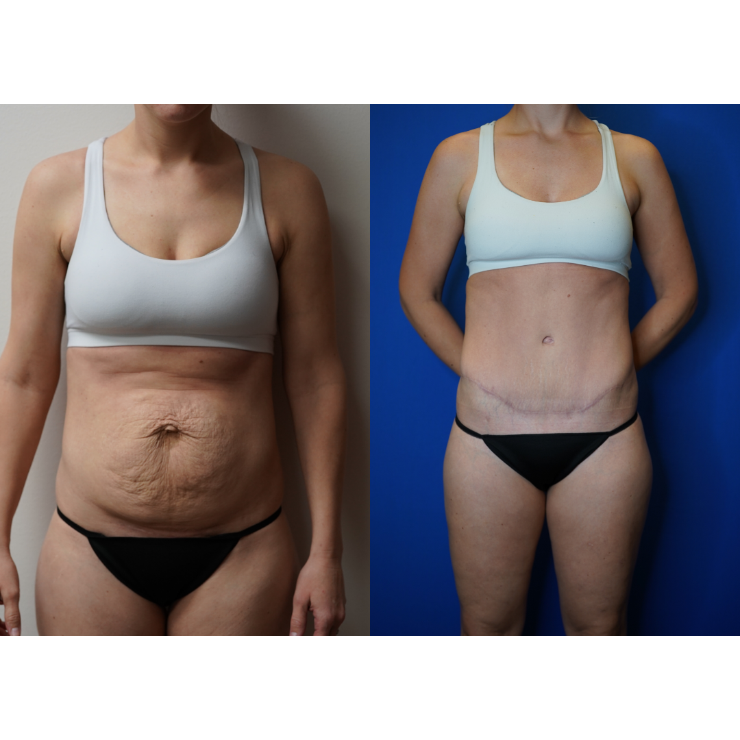  Details: Abdominoplasty with liposuction to flanks and thighs. 