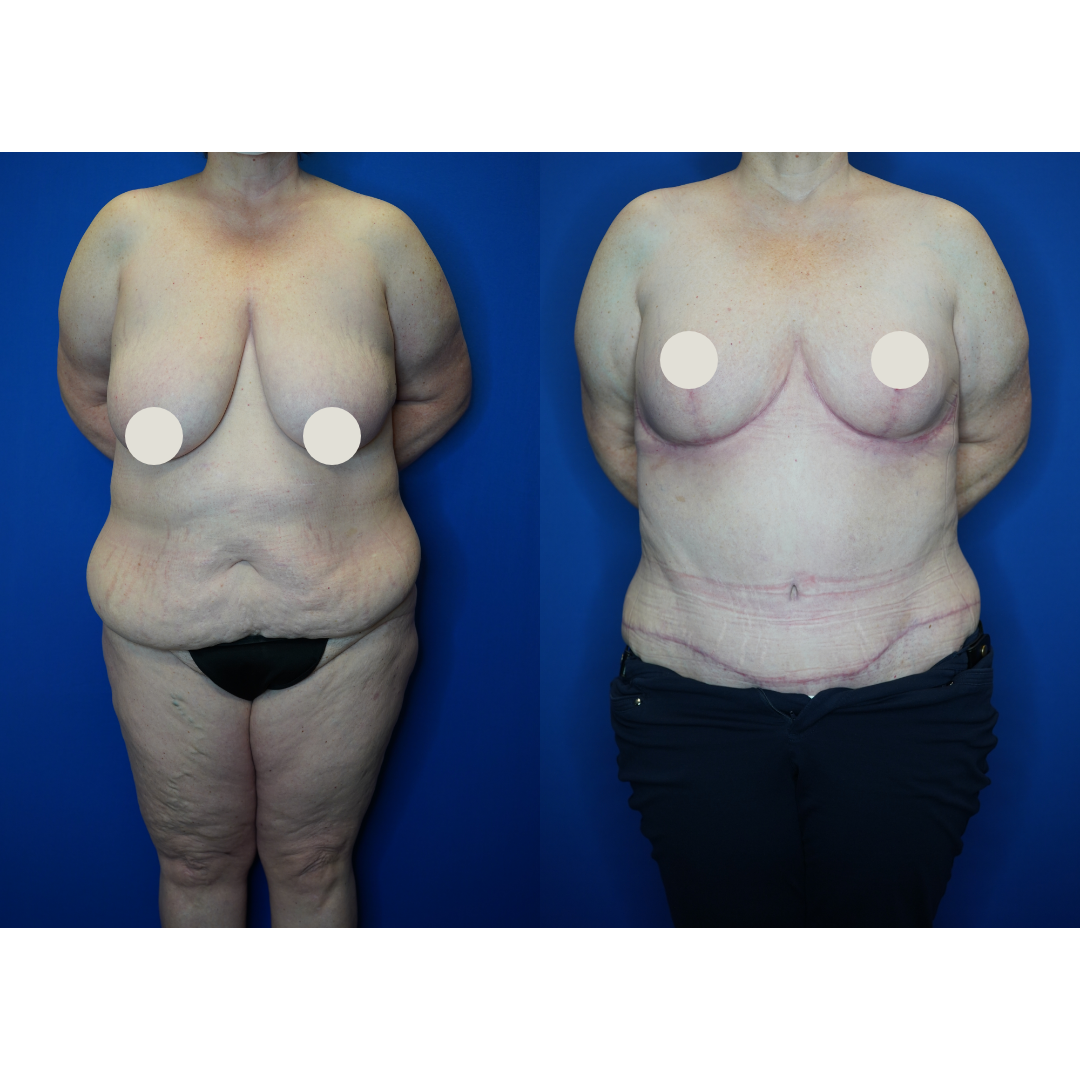  Details: Extended abdominoplasty with Bilateral breast reduction 