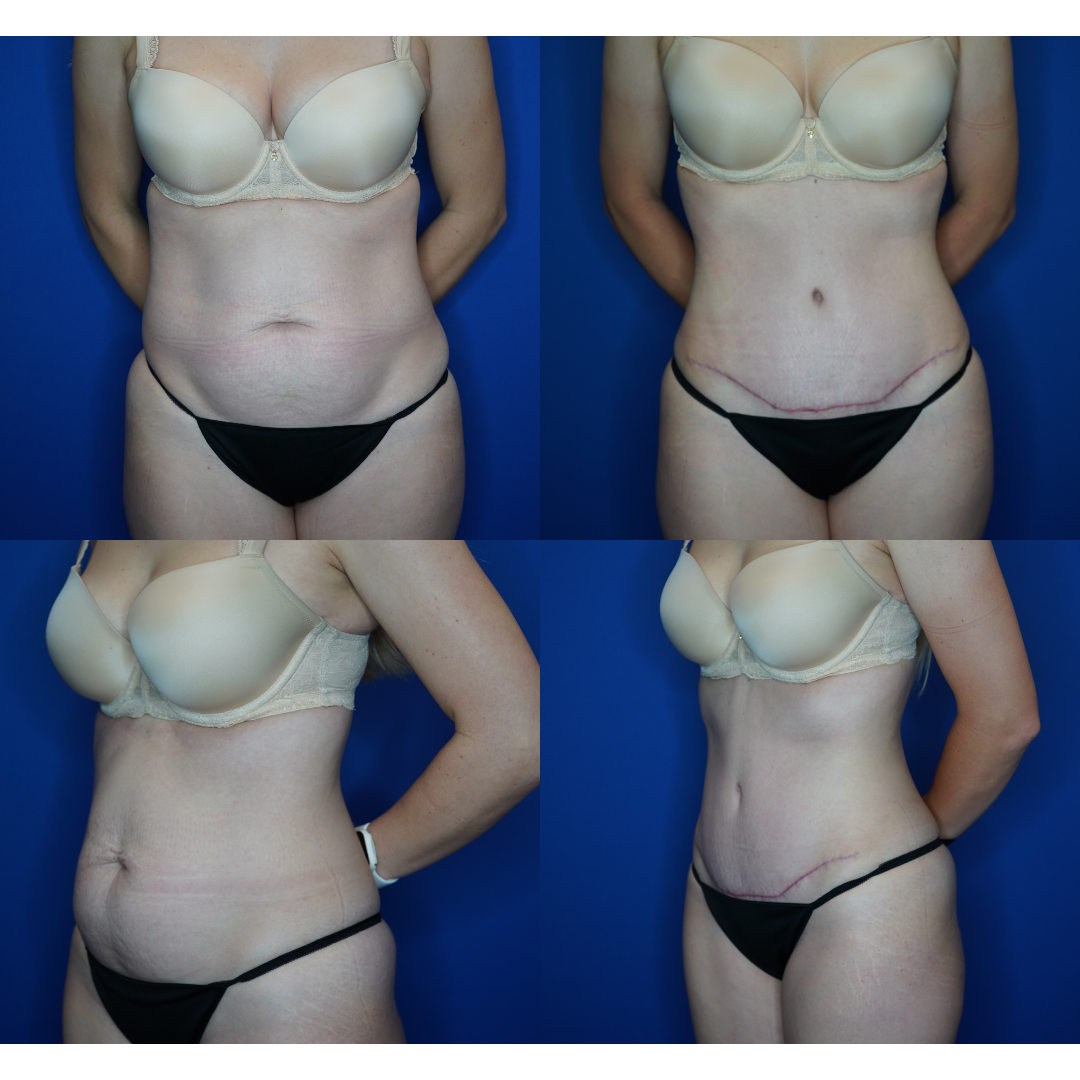  Details: Standard abdominoplasty with liposuction AND liposuction TO bilateral flanks 