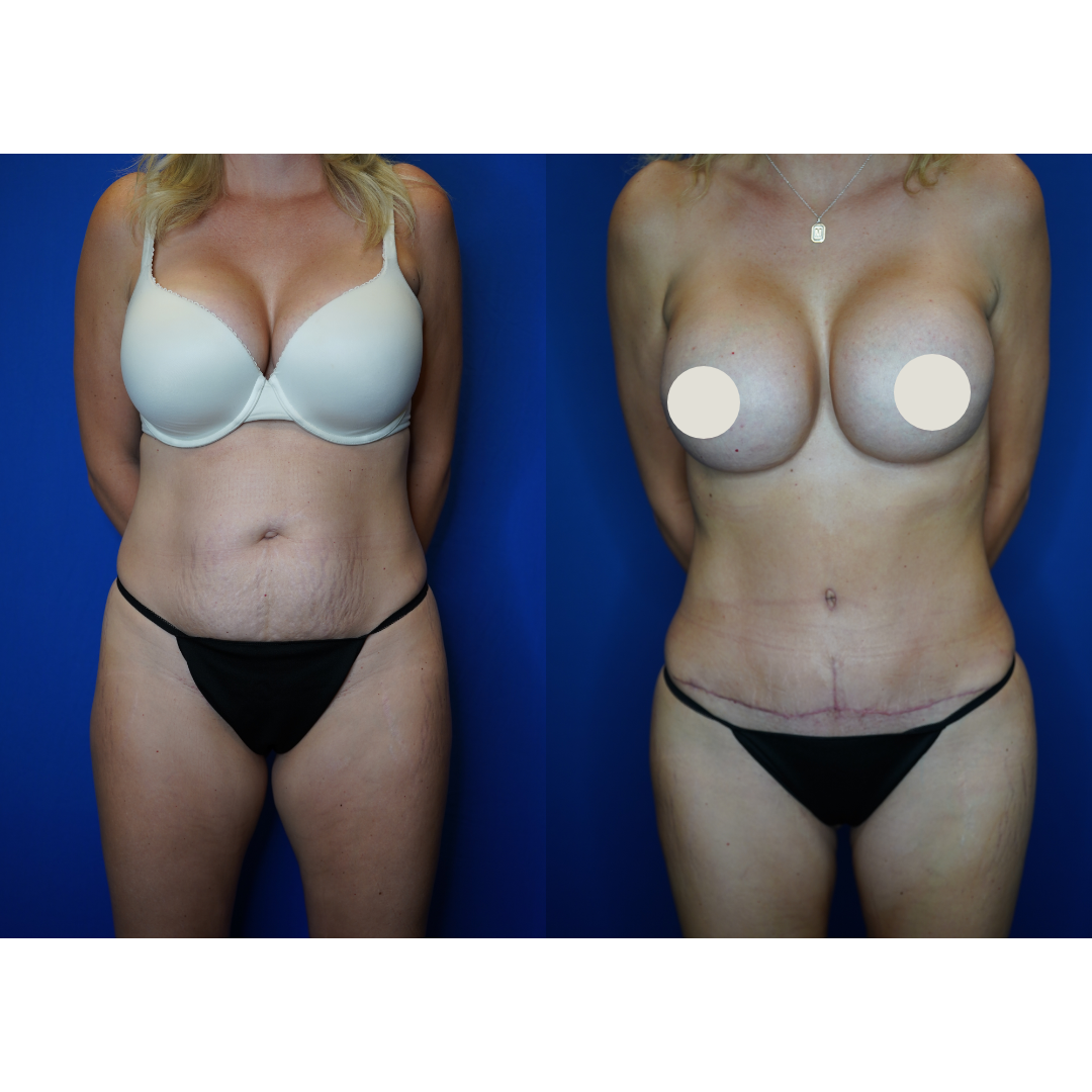  Details: Standard abdominoplasty with liposuction and bilateral implant exchange 