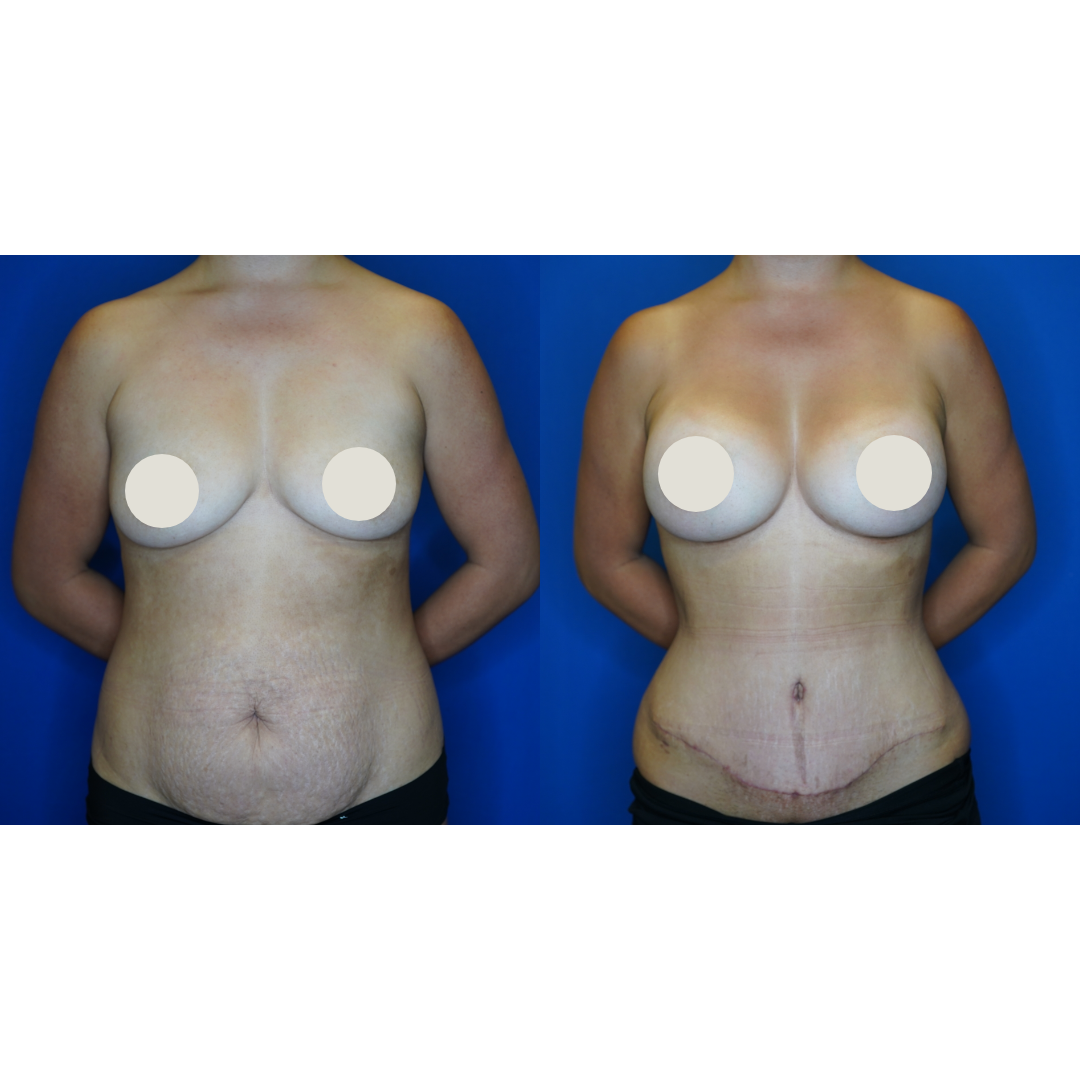  Details: Standard abdominoplasty with bilateral augmentation, liposuction to flanks, fat grafting to bilateral breasts  &nbsp; 