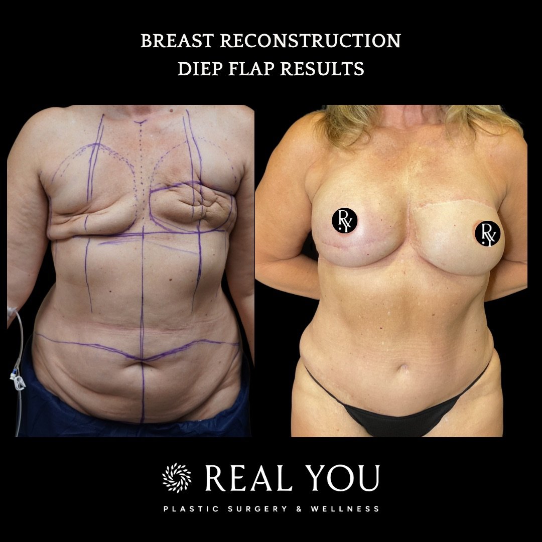 BILATERAL BREAST DIEP - 2.jpeg