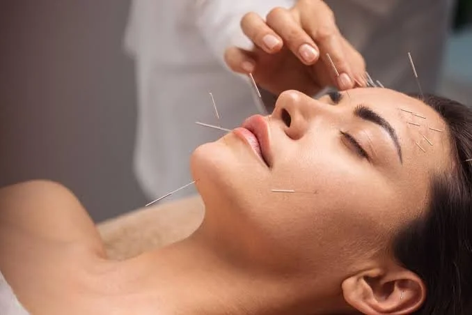 A woman lying down receiving acupuncture treatment on her face with thin needles being inserted by a practitioner.