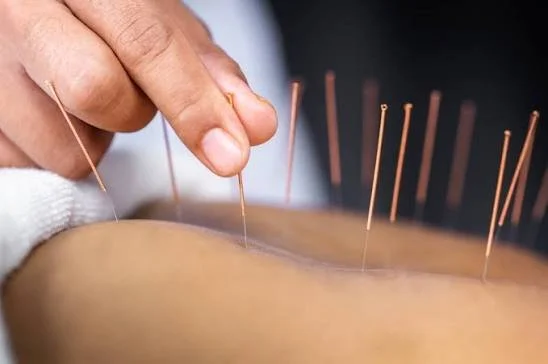 Acupuncturist inserting thin acupuncture needles into a patient's skin.