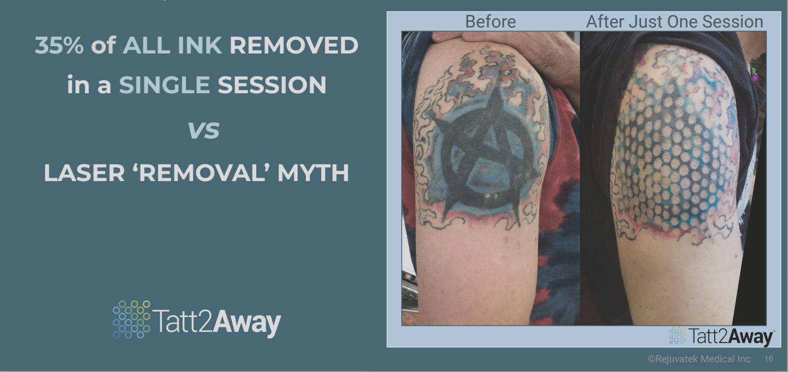 Side-by-side comparison of a person's upper arm showing a tattoo before and after one session of a laser removal treatment. The 'before' image shows a tattoo with a large black symbol and colorful flame-like design, while the 'after' image shows the 