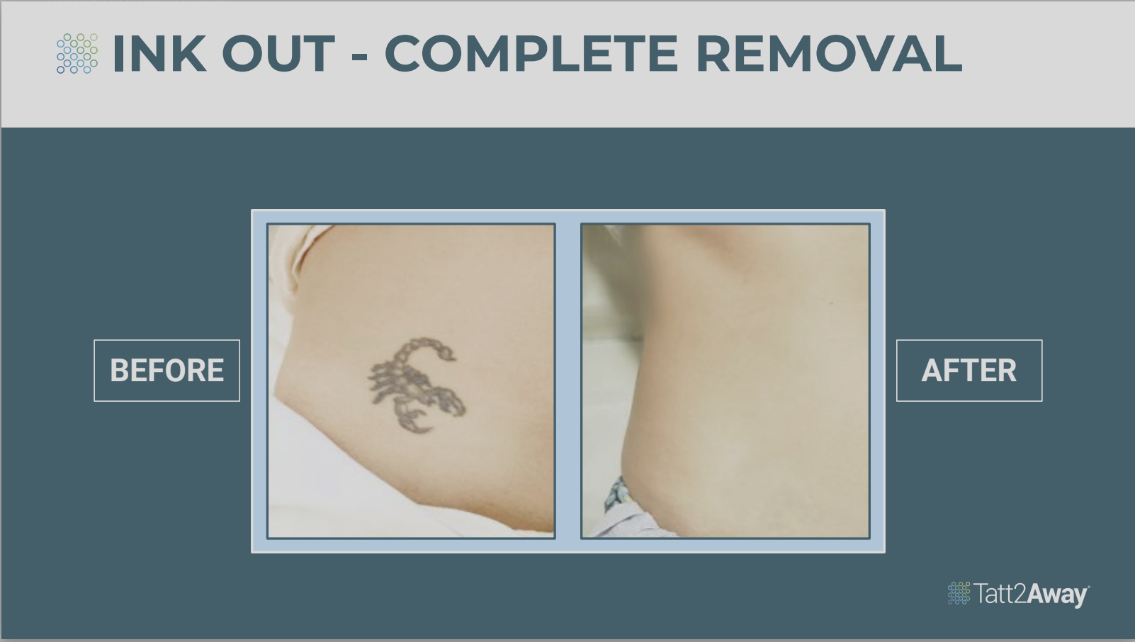 Comparison of a person's side waist area with a black tattoo of a dragon in the "before" image and no tattoo in the "after" image, illustrating tattoo removal.