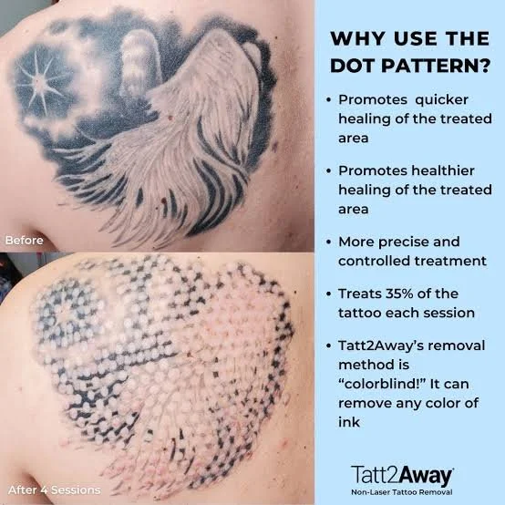Comparison of a tattoo before and after four sessions demonstrating the effectiveness of the dot pattern technique for tattoo removal, along with a list of benefits of using the dot pattern for tattoo removal.