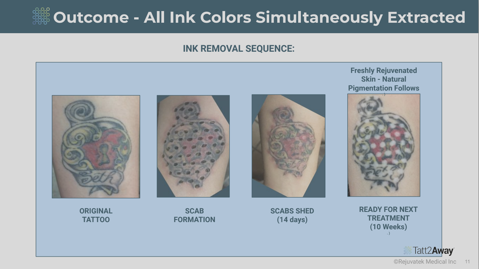 Step-by-step progression of tattoo ink removal process involving a tattoo of a decorative bottle. The first image shows the original tattoo, the second shows the tattoo after scab formation, the third shows the tattoo after scab shed in 14 days, and 