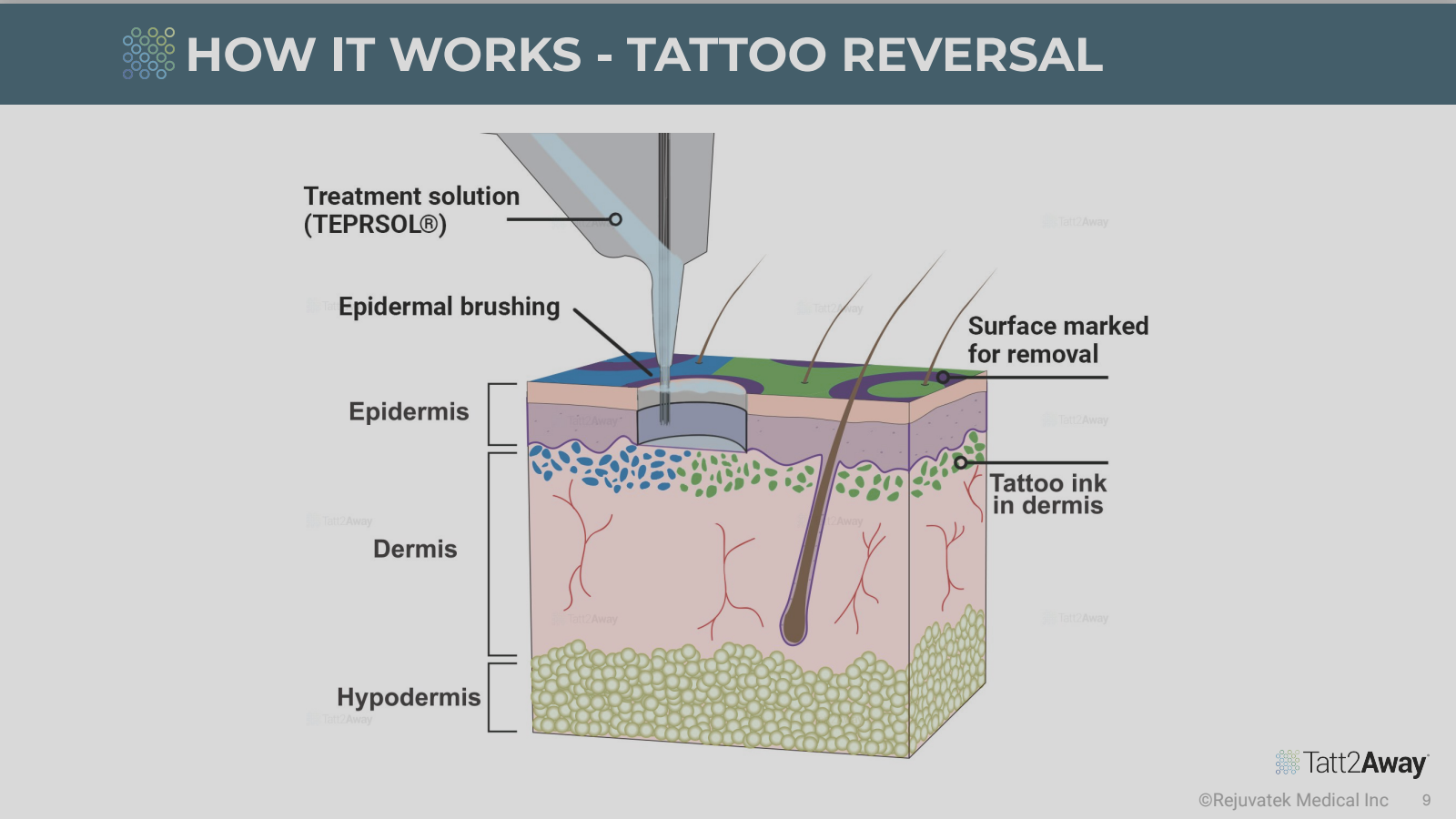 Diagram showing the process of tattoo reversal using treatment solution, epidermal brushing, and surface marking for removal, highlighting layers of skin and tattoo ink in dermis.