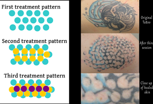 Comparison of tattoo healing stages and treatment patterns; top shows original tattoo, middle shows tattoo after third session, bottom shows healed skin close-up.