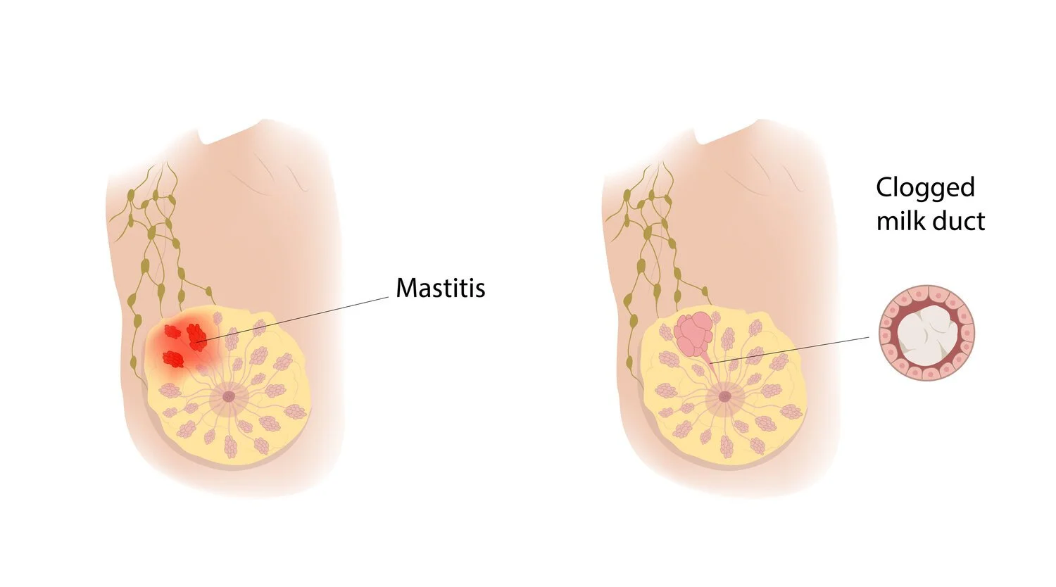 Mastitis Milk