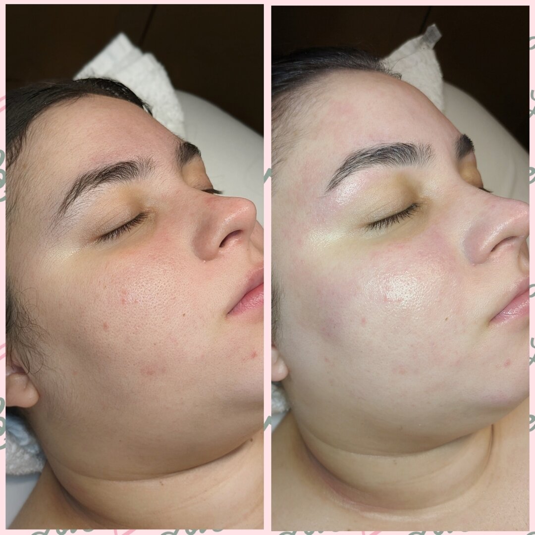 This babe got a dermaplaning facial with a hydrojelly mask and a brow wax. 

Dermaplaning is one of my favorite treatments to do! Not only does it take off dead skin it also takes away that pesky peach fuzz we all love to hate. 

TIP: Add a peel afte