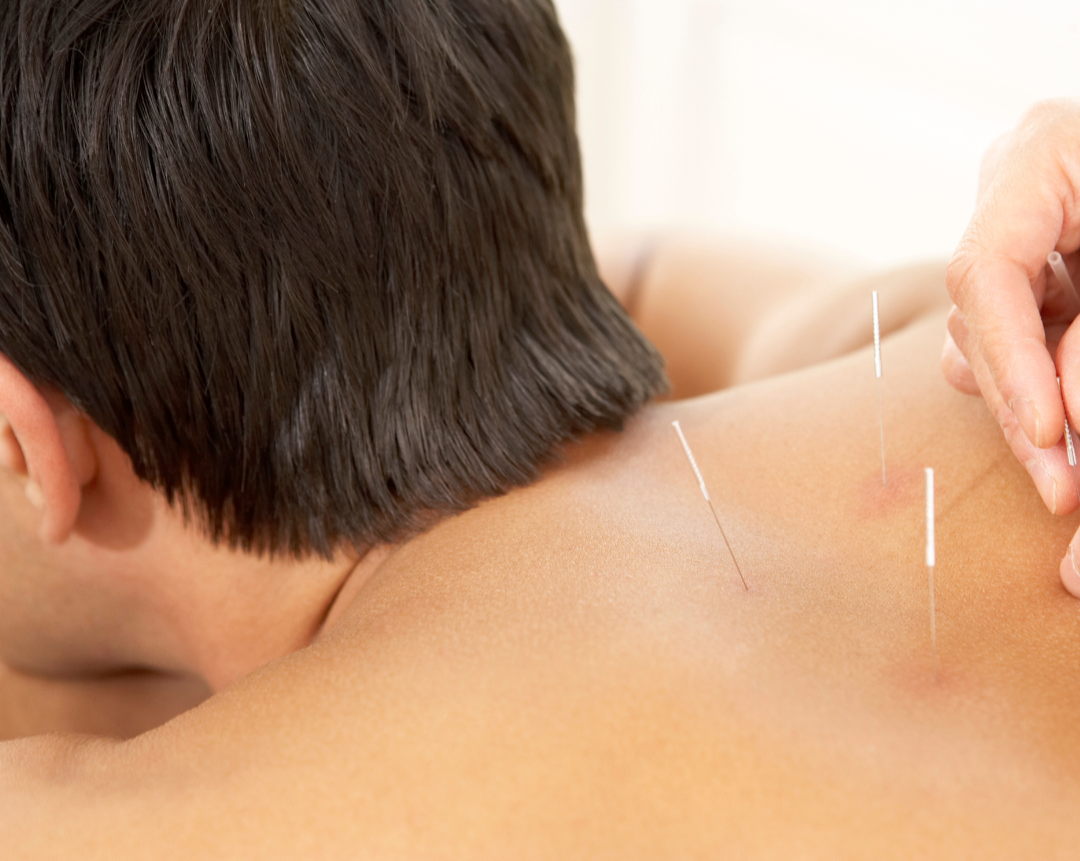 Acupuncturist placing needles in a male patient's upper back and neck during a men's health treatment in NW Calgary