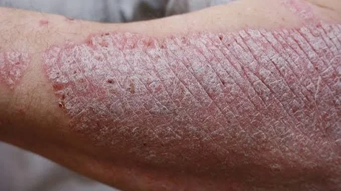 Acupuncture treatment for psoriasis and chronic skin conditions in Calgary