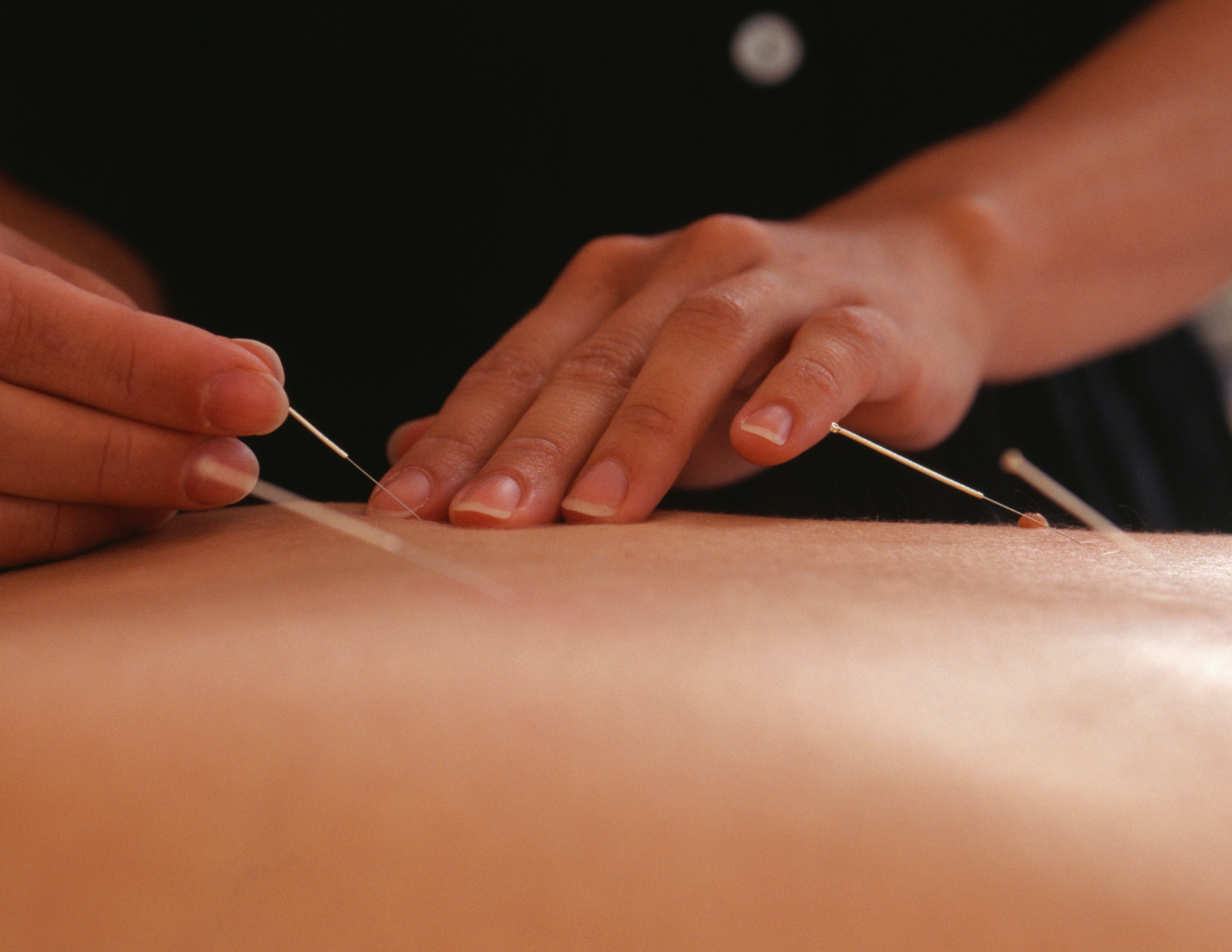 Dr. Joseph Coccagna performing acupuncture on a female patient at his NW Calgary clinic