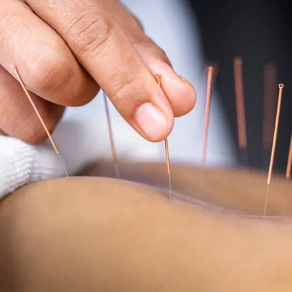 Is Acupuncture Covered by Insurance in Alberta?