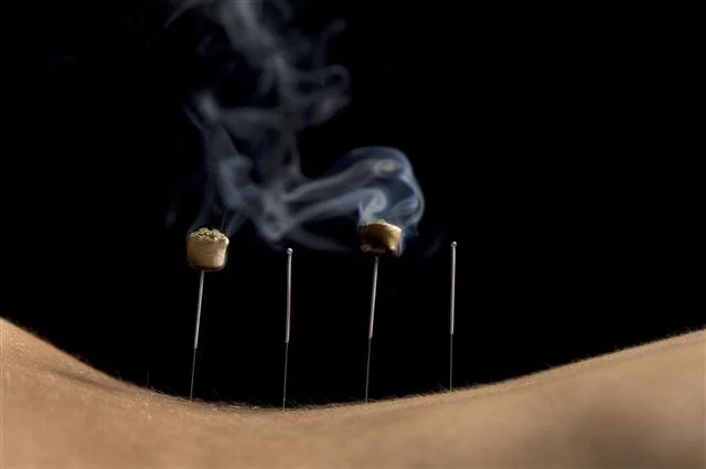 What to Expect at Your First Acupuncture Appointment in Calgary
