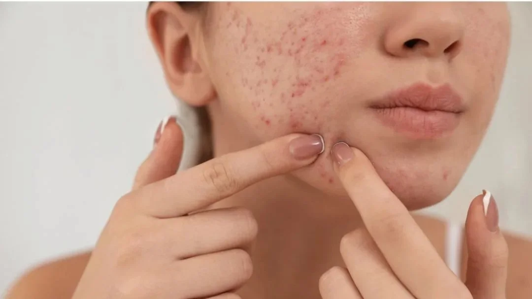 Acupuncture for Acne in Calgary