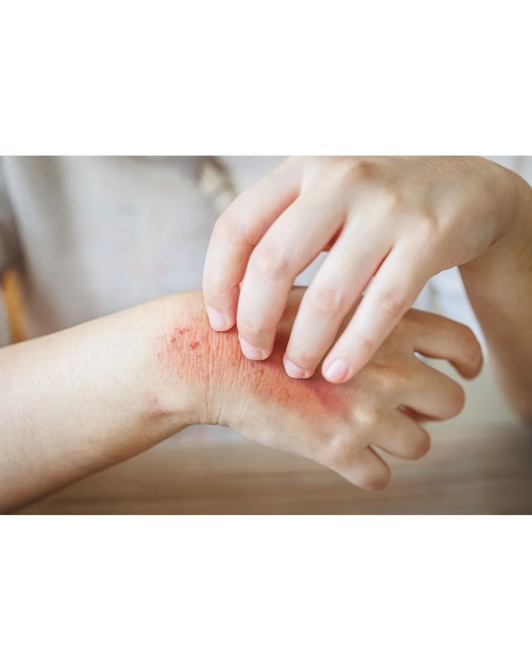 Acupuncture for Eczema in Calgary