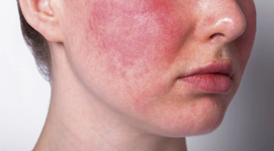 Acupuncture for Rosacea in Calgary