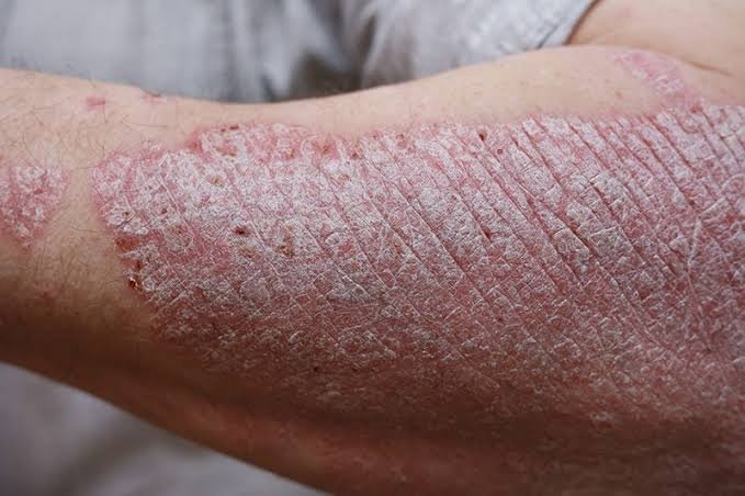 Acupuncture for Psoriasis in Calgary