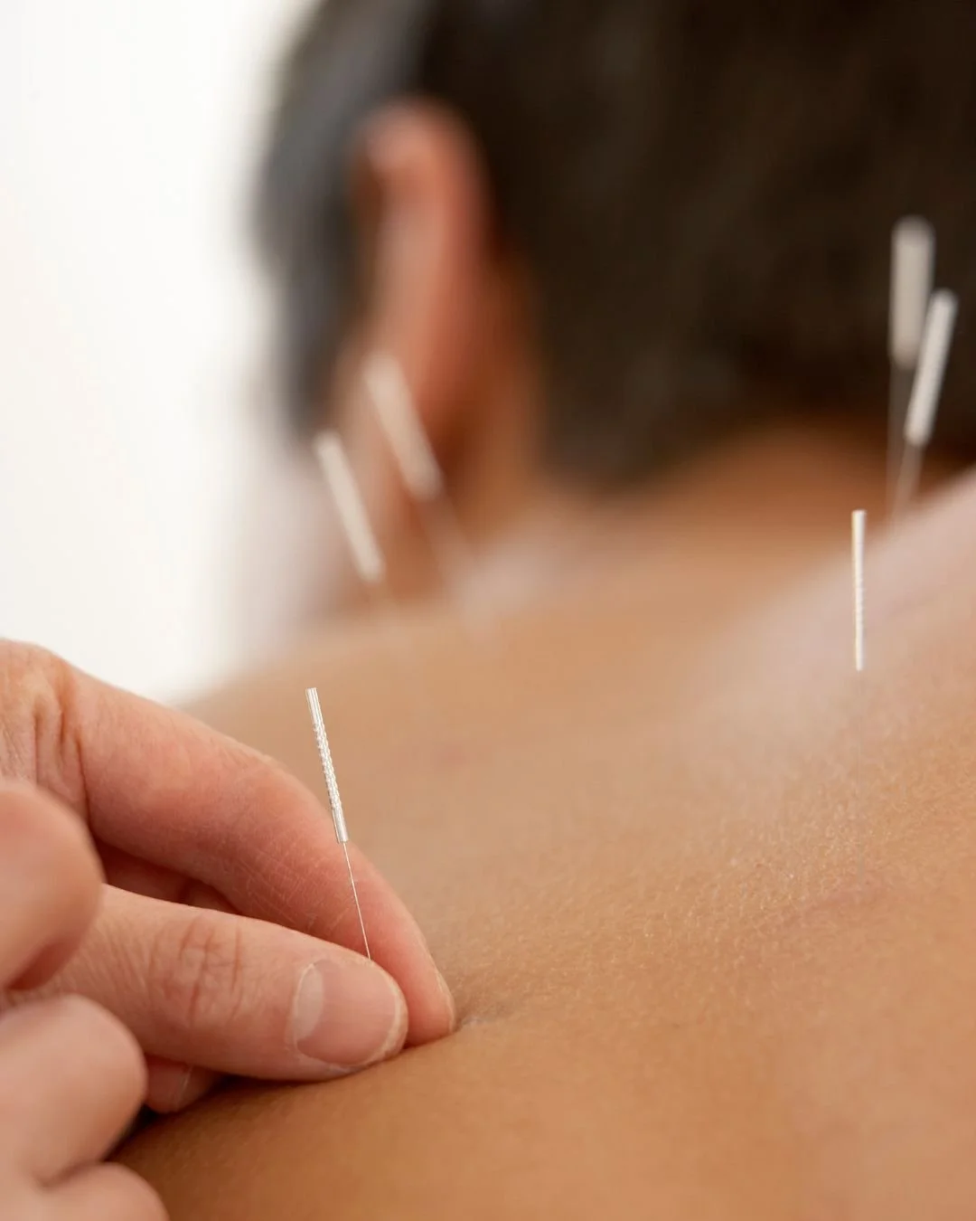 calgary acupuncture patient receiving care for mental emotional health concerns
