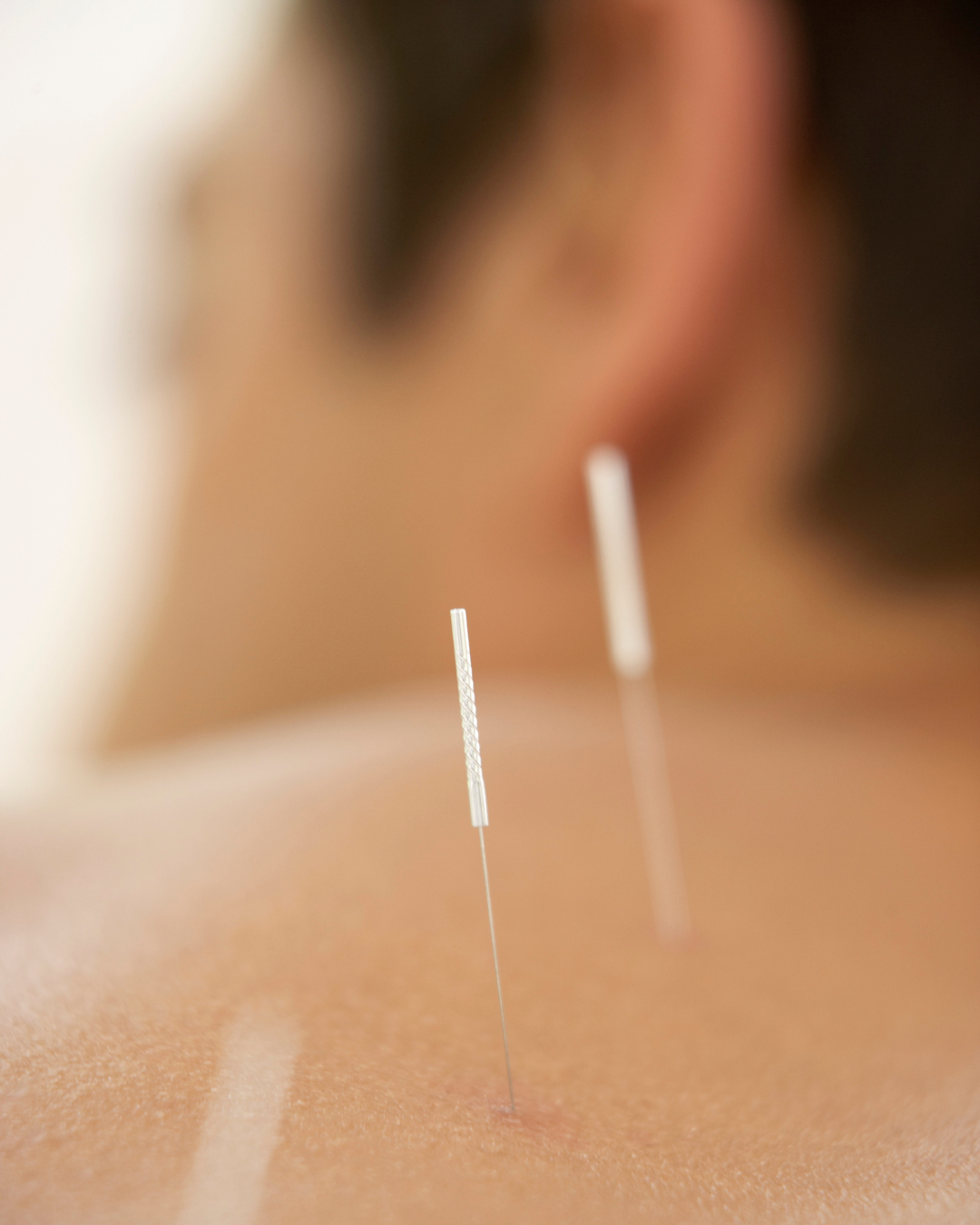 Acupuncture needles placed in a male patient's back during a men's health treatment at Joseph Coccagna Acupuncture in NW Calgary