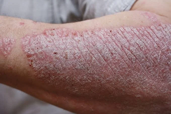acupuncture patient with psoriasis in calgary