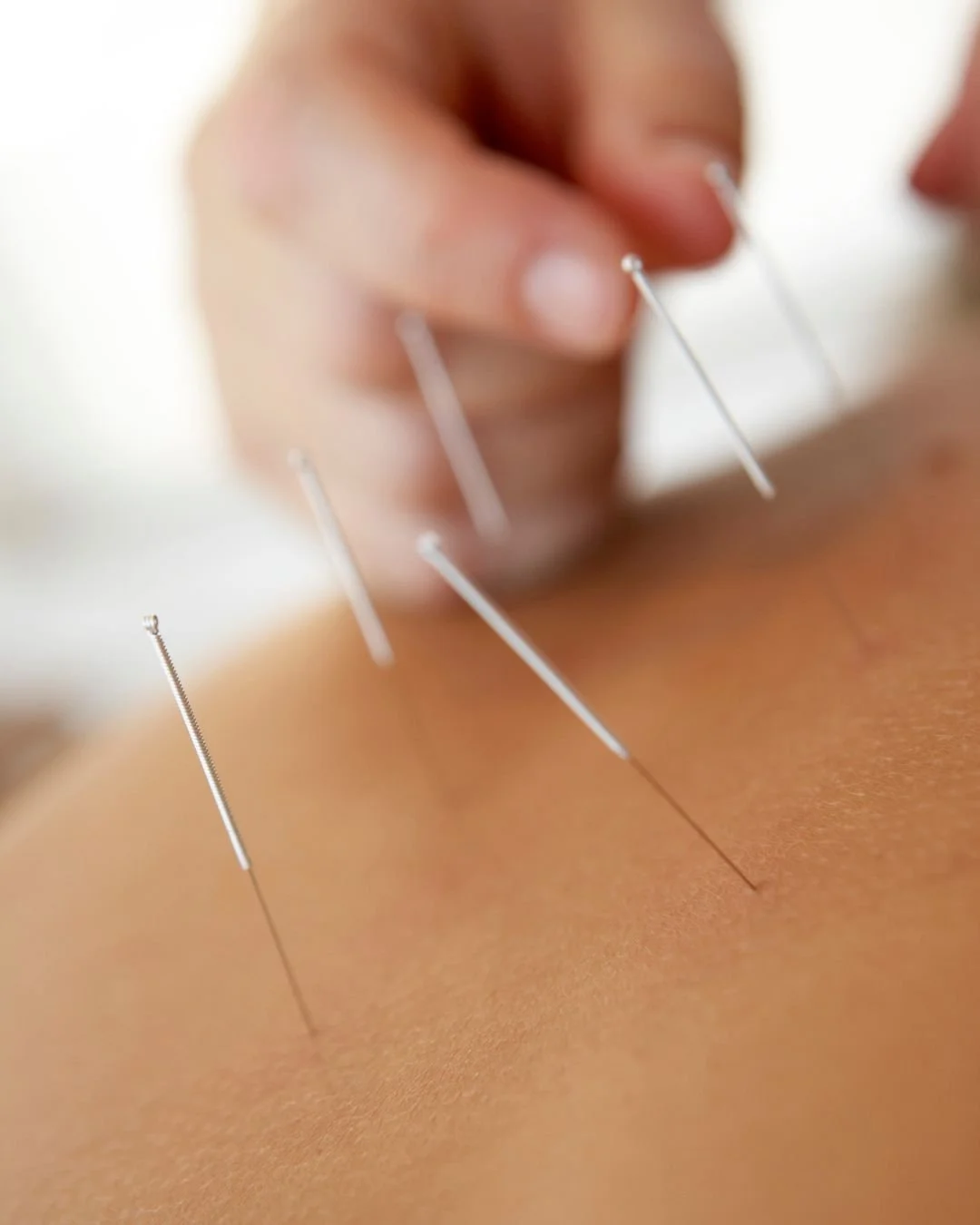 calgary acupuncture patient receiving care for mental health concerns