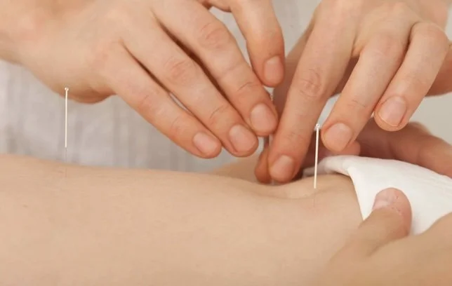 Acupuncturist placing a needle into a child's hand during a pediatric acupuncture treatment in NW Calgary