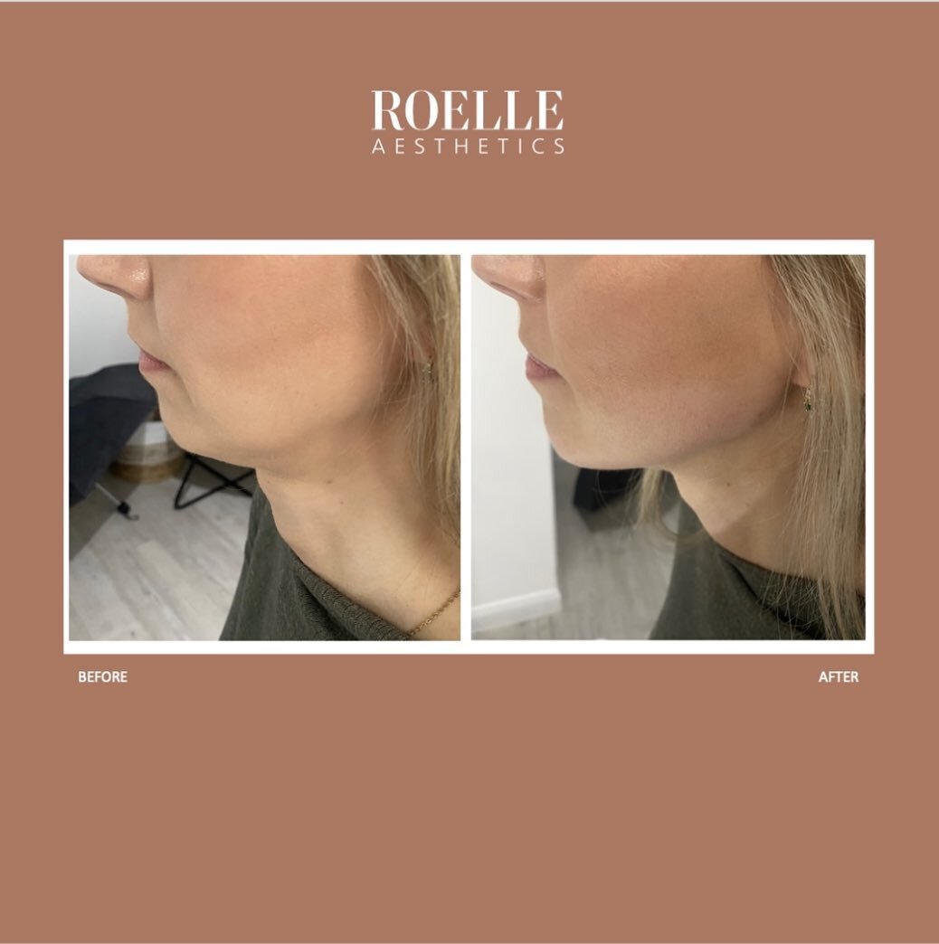 Before &amp; After 

💉 Jawline treated with hyaluronic acid using just 2mL of product
🎯 Improving jawline definition
💵 &pound;440
🕰️ These results after the 1 treatment
🗓️ Results maintained with &pound;280 spend every 4-5 months 

#antiwrinkle 