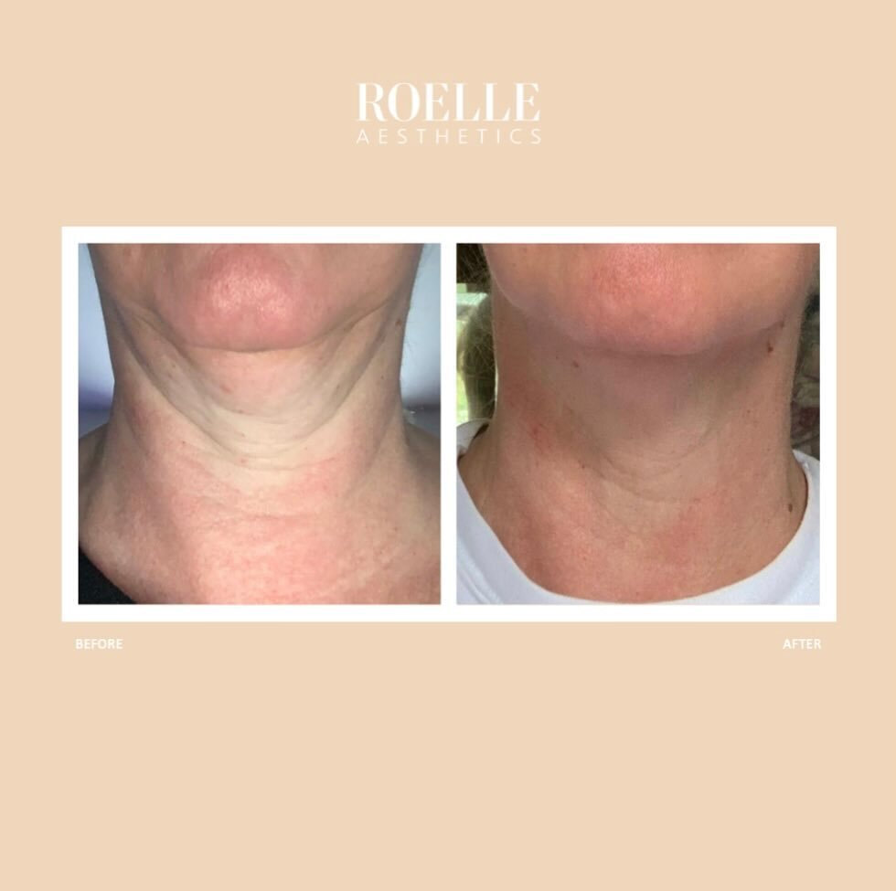 Before &amp; After 

💉 Neck treated with Profhilo
🎯 Improves skin quality and texture
💵 &pound;750 for a course of 3 treatments 
🗓️ Results maintained with &pound;300 spend every 6 months 

#antiwrinkle #fillers #antiageing #profhilo #skinbooster