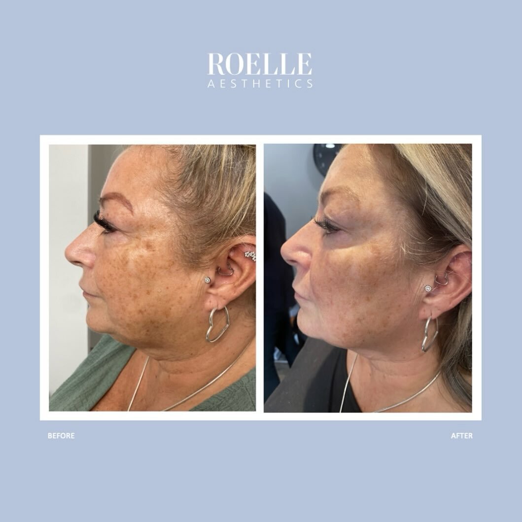 Before &amp; After 

💉 Full face rejuvenation with HA filler
🎯 Lifted look with jawline definition and improved mid face volume using 6mL of product
💵 &pound;1250
🗓️ Results maintained with &pound;300 spend every 6 months 

#antiwrinkle #fillers 