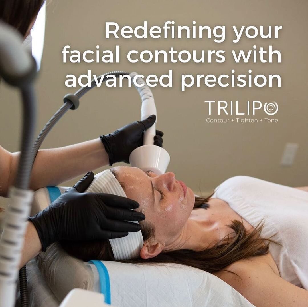 Facial contouring with TriLipo is a procedure that uses special technology to shape and sculpt the face without surgery. It combines radiofrequency (RF) energy and dynamic muscle activation (DMA) to target different layers of the skin and facial musc