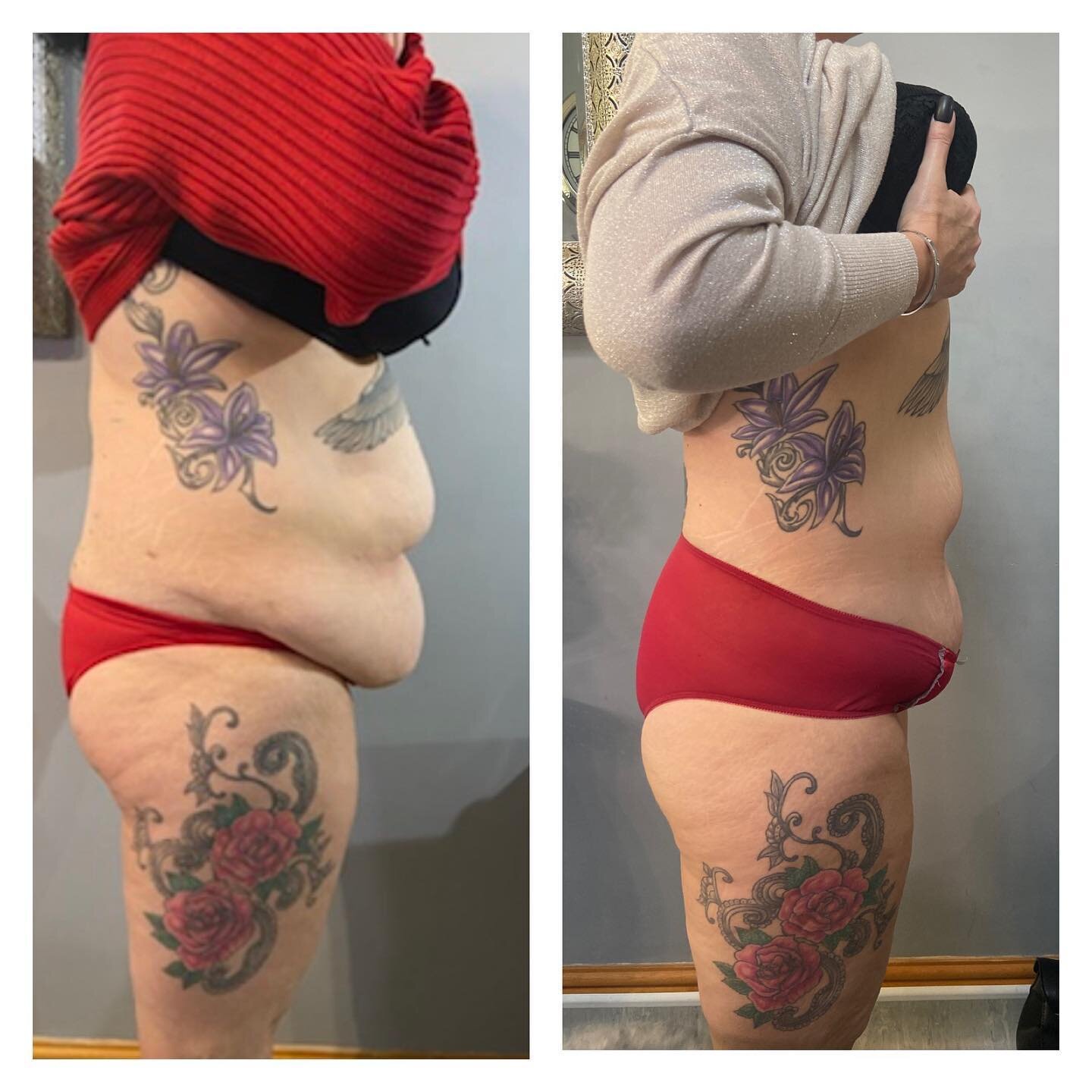 Lipofirm Tummy Tuck is designed specifically to tighten the skin, reduce fat cells, tone muscle and stimulate tissue repair to the abdomen area. 

This treatment uses TriPollar radio frequency technology to rekindle new collagen production in the bod