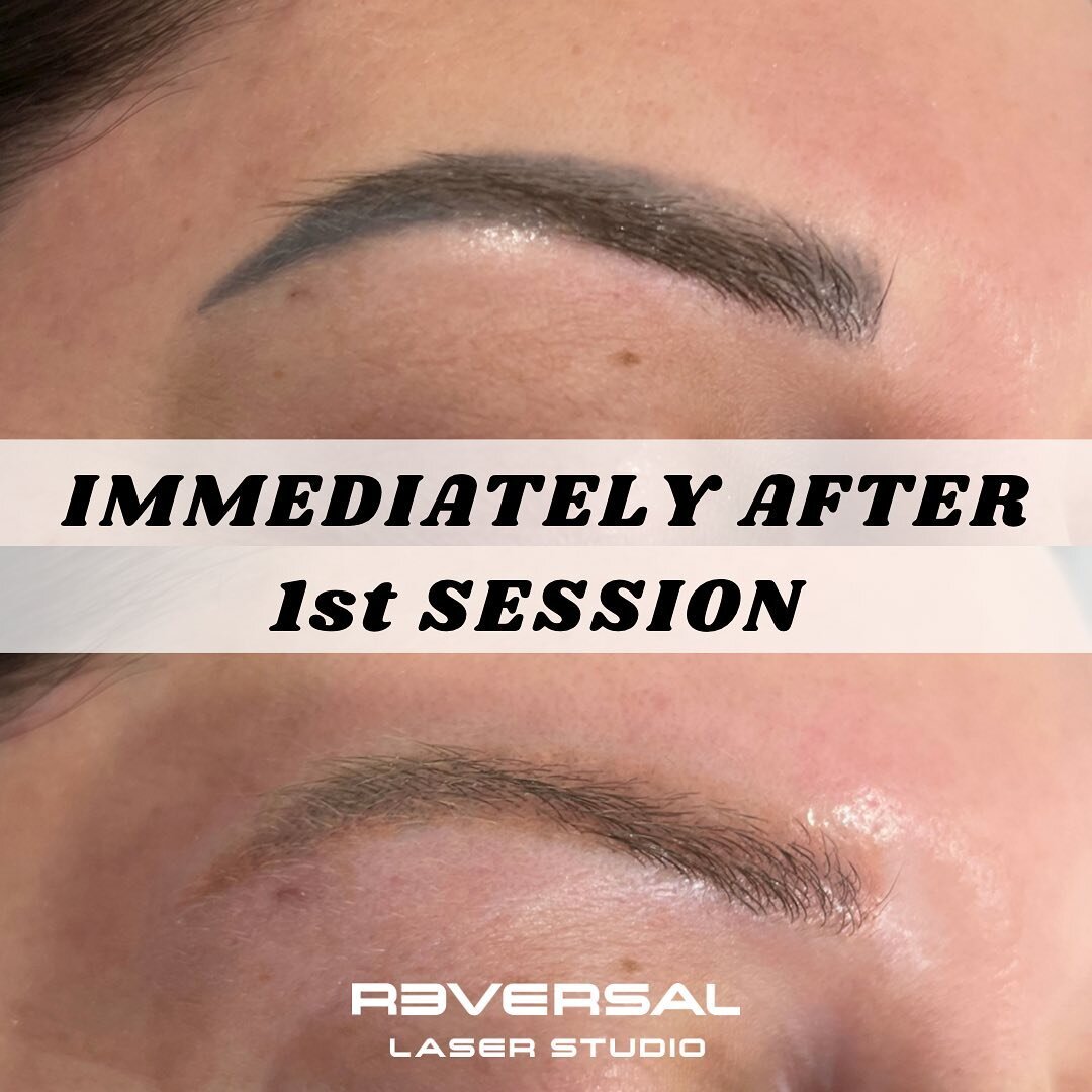 Here are a set of brows we recently worked on. This photo was taken immediately after the treatment.

As you can see there is some warmth left behind, which is quite common. We will be treating this color during the next appointment.

The brow hairs 