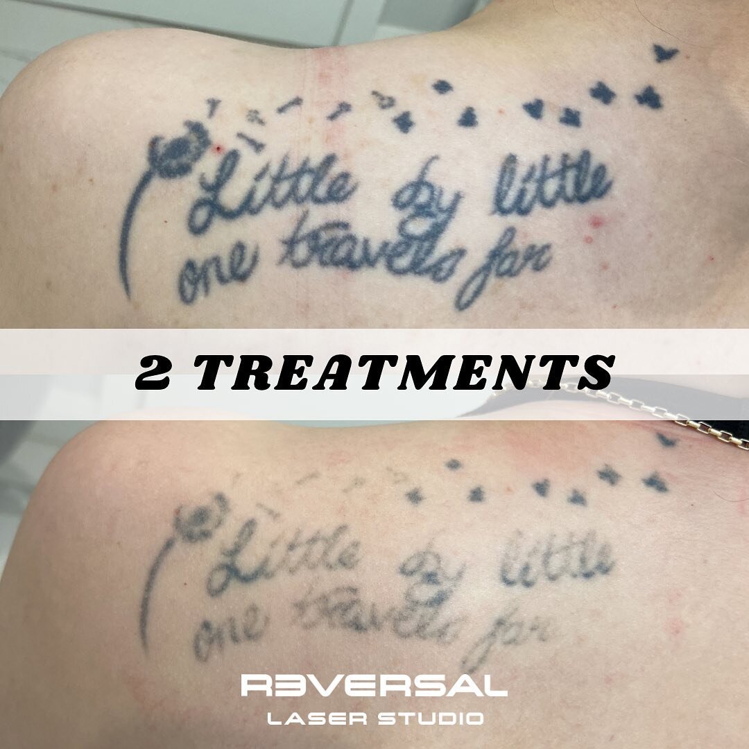 Enlighten Laser Tattoo Removal  Rao Dermatology
