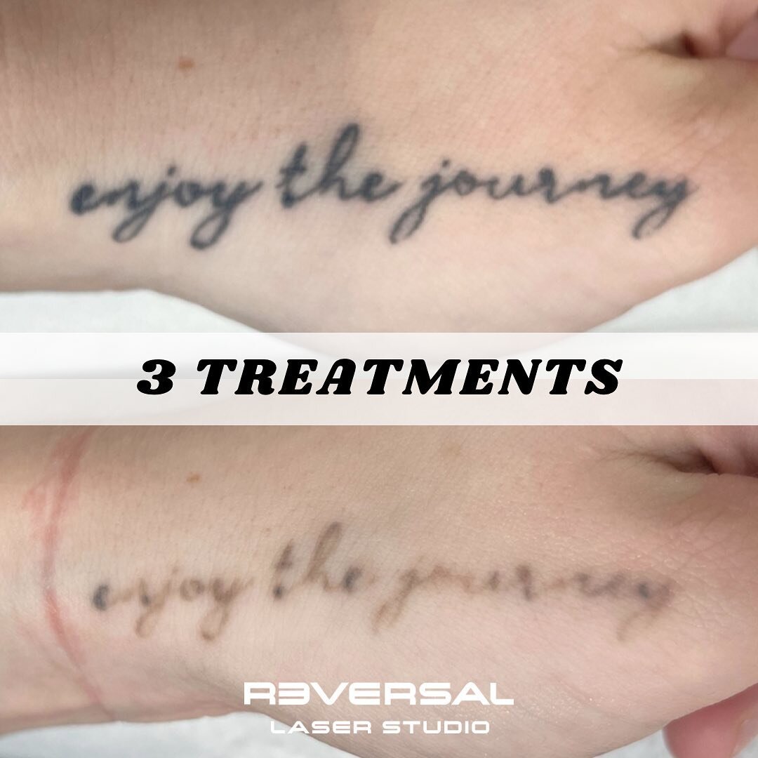 Here are the progress photos after 3 treatments on a hand tattoo that is 2-3 years old.

⚡️ We just did another session to further lighten it!

Individual results may vary.

Contact us for a free consultation
Text/Call: 780-800-5757
info@reversalstud