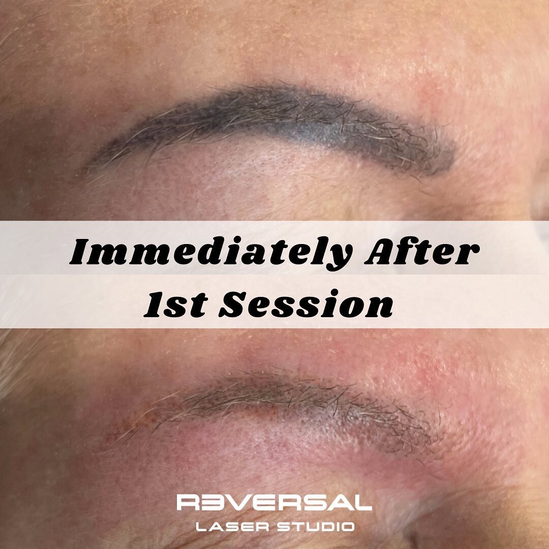 Here is a recent set of brows we worked on and achieved really great results immediately after the first session.

Our client was on a very tight schedule to have her brows removed in order to have them redone again. Luckily she was referred to us an